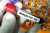 В Україні вже зафіксували третій випадок мавпячої віспи, — МОЗ