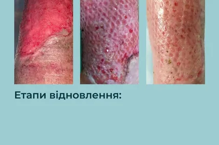 Так виглядала гомілка пацієнтки до проведення лікування (перше фото зліва) і у процесі одужання. Фото пресслужби Другого медоб’єднання Львова