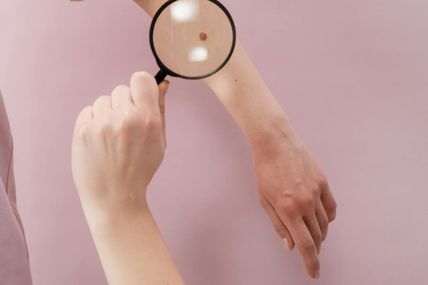 Місяць інформації про меланому: як вберегти себе від найагресивнішого раку шкіри