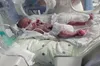 На Львівщині недоношений малюк із вагою 890 грамів успішно завершив лікування в перинатальному центрі