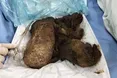 Львівські лікарі видалили кілограм волосся зі шлунка 15-річної дівчинки